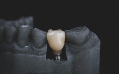 Implantes Dentales: Qué son y cuándo se recomiendan